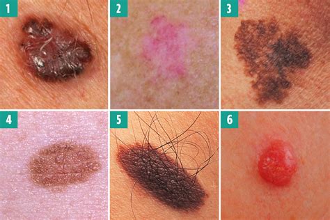 skin cancer red moles